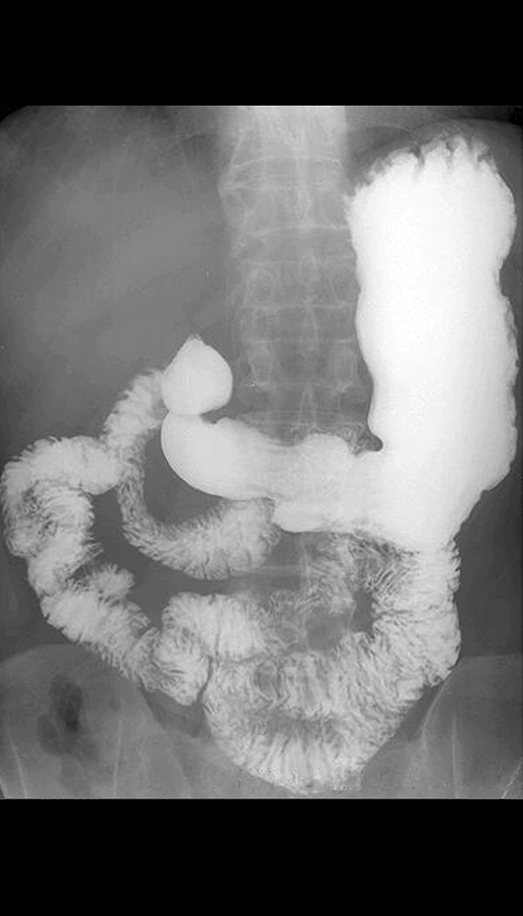 barium-upper-gi-study-normal-stomach